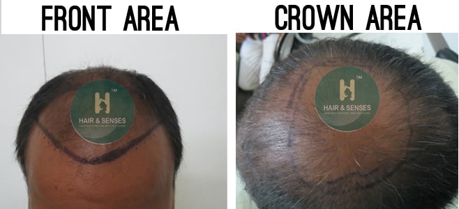 Hair Transplant Case Study